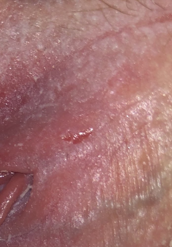 Herpes or Yeast infection cuts?