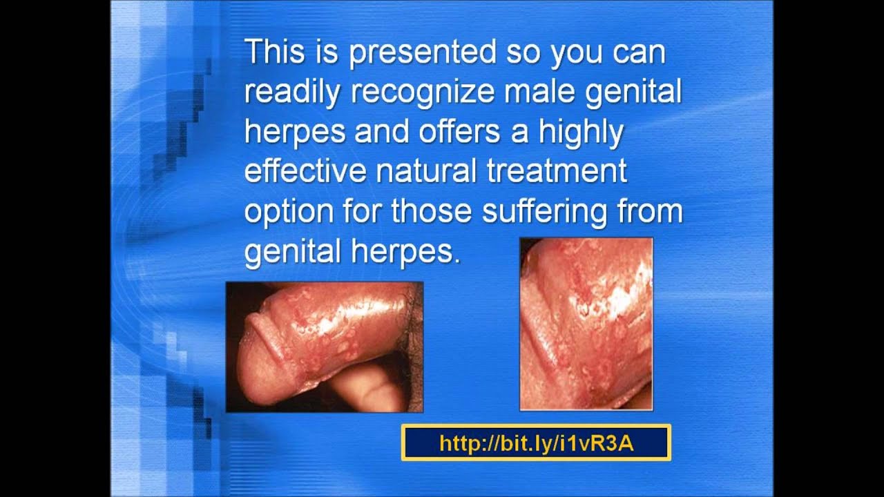 MALE GENITAL HERPES Pictures Photos