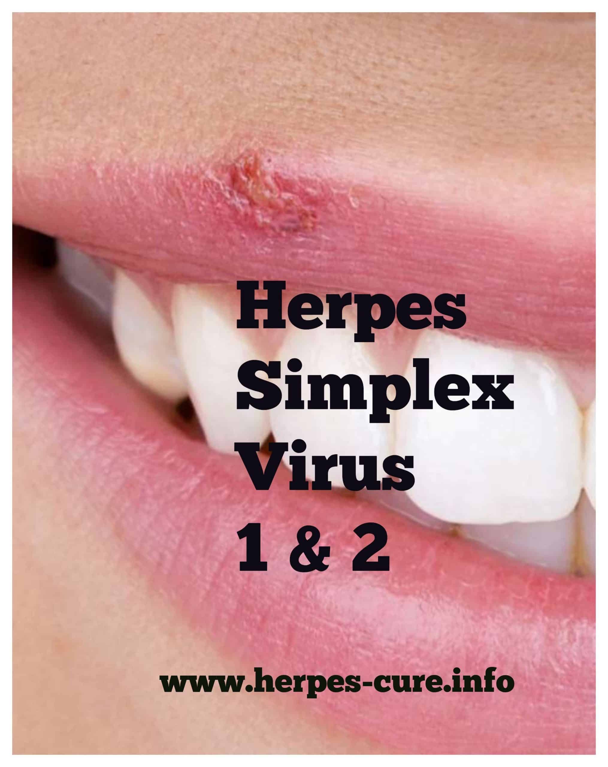 When is genital herpes no longer contagious  Health News